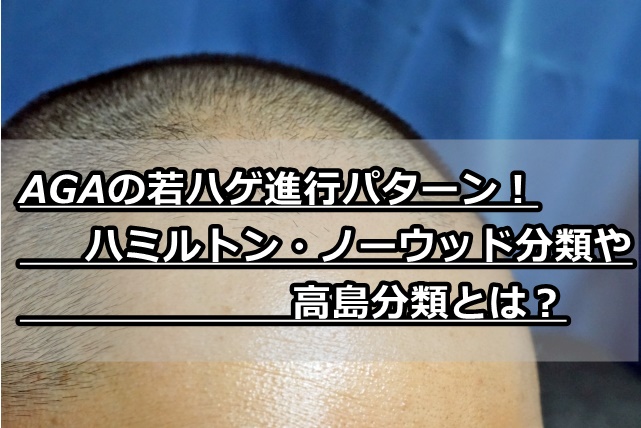 ハミルトン ノーウッド分類や高島分類とは Aga若ハゲ進行種類を解説 Aga保健室 カッパ先生と学ぶ発毛 育毛のすべて