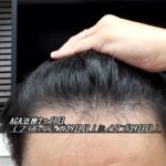 AGA治療2ヶ月目（フィンペシア39日目｜ミノタブ39日目）くせ毛が改善