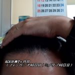 AGA治療2ヶ月目（フィンペシア46日目｜ミノタブ46日目）手の毛やばい…