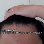 AGA治療3ヶ月目（フィナステリド・ミノタブ62日目）背中の毛が多毛